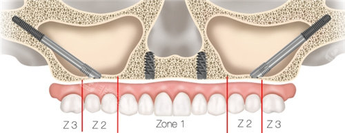 穿颧穿翼种植分区图解