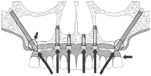 穿颧穿翼种植牙示意图