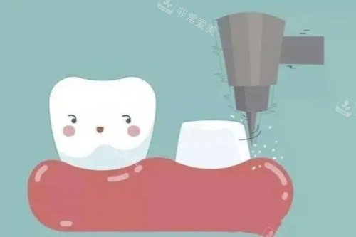 牙齿打桩卡通图