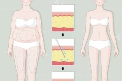 吸脂卡通前后对比一览图