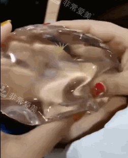 丰胸手术傲诺拉隆胸假体手感