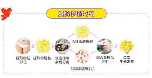 脂肪移植过程