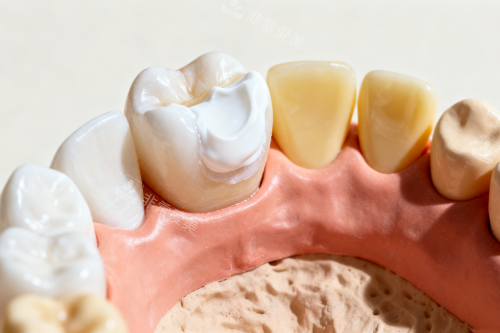 牙齿镶牙卡通展示图