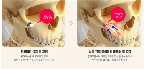 颧骨部位解析图 颧骨部位解析图