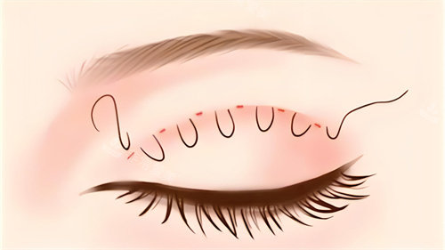 杭州蔡佳沁医生双眼皮怎么样？技术好！眼科背景+精细术式+自然妈生款+眼型定制！