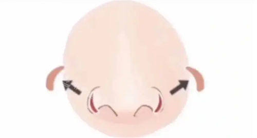 鼻翼宽大动画展示图