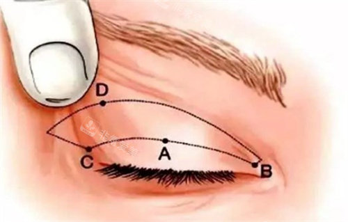 全切双眼皮术前设计 全切双眼皮术前设计
