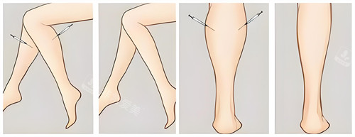 腿部吸脂手术前后对比动画图 腿部吸脂手术前后对比动画图