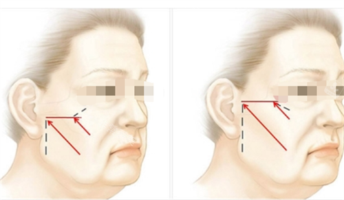中上面部拉皮提拉方向画线图 中上面部拉皮提拉方向画线图