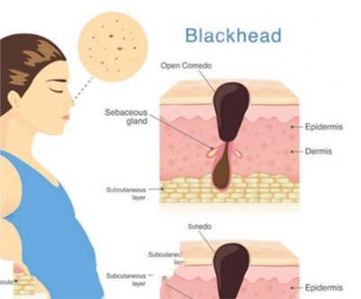 皮肤毛孔粗大示意图 皮肤毛孔粗大示意图