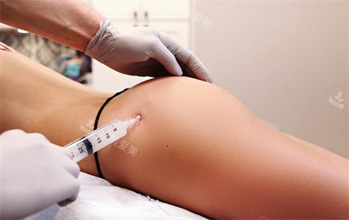 不明注射物丰臀中 不明注射物丰臀中