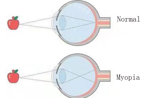 近视眼与正常眼对比