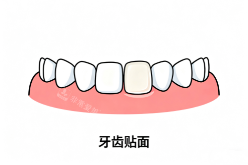 牙齿贴面卡通展示图