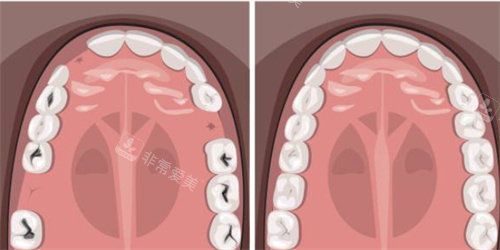 牙齿缺失补牙示意图