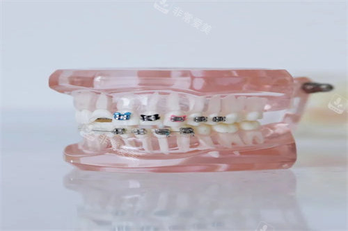 牙齿矫正的模型图