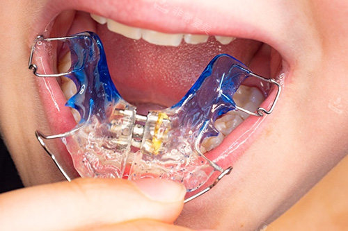 牙齿矫治器示意图