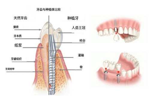 种植牙构造图