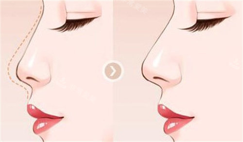 2026国内隆鼻修复有名的医生汇总:李保锴|牛勇敢|吴玉家等11位医生实力口碑揭秘