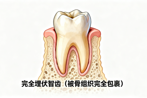 完全埋伏智齿一览