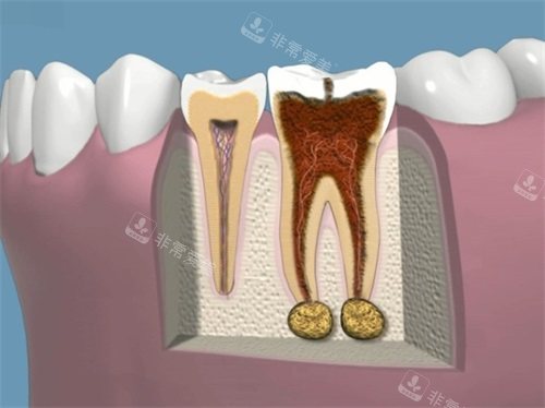 牙齿龋坏根管治疗前