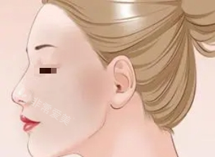 光子嫩肤示意图 光子嫩肤示意图