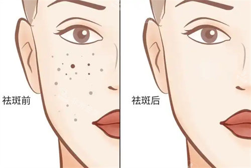 祛斑前后对比