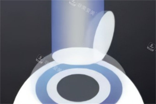 半飞秒准分子激光切削角膜