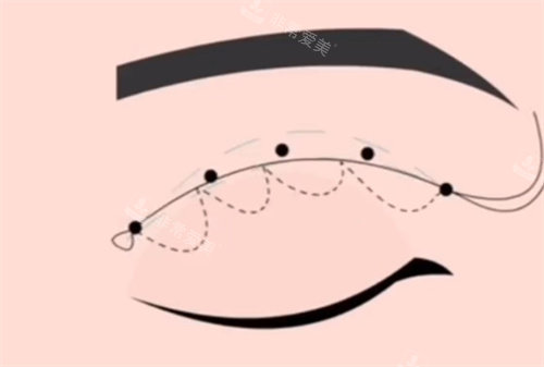 埋线双眼皮
