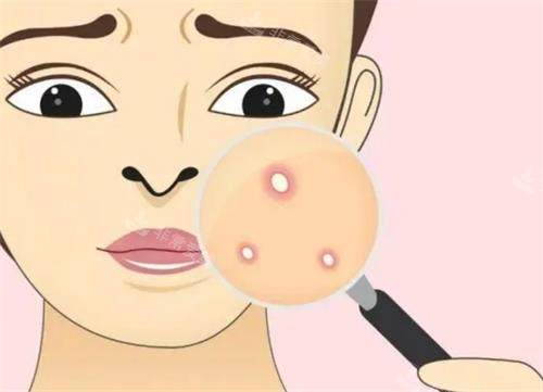 痘痘的示意图