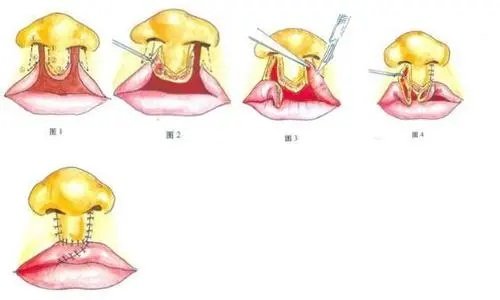 唇裂鼻修复图