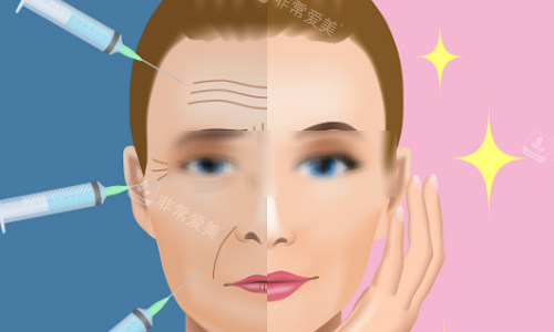 韩国面部脂肪填充手术真实经历，面诊精细设计合理/自体脂肪存活率高/面部饱满显幼态超满意！