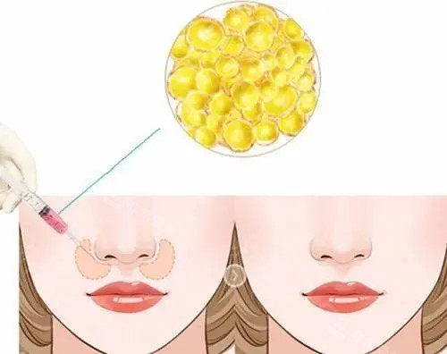 脂肪填充鼻基底位置示意图 脂肪填充鼻基底位置示意图