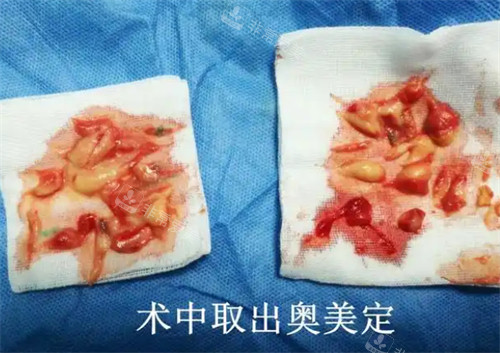 术中取出的奥美定