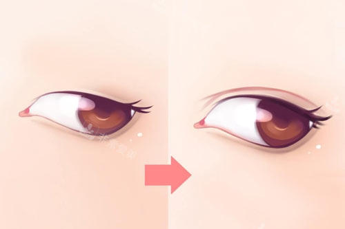 双眼皮整形图 双眼皮整形图