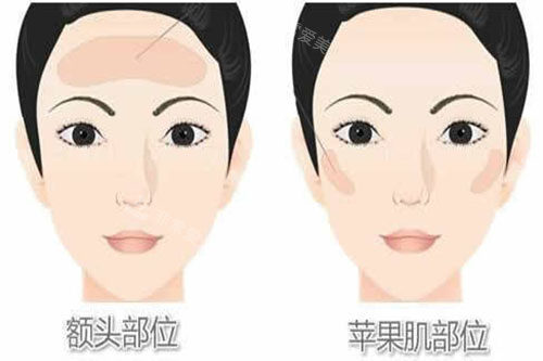 脂肪填充部位展示图