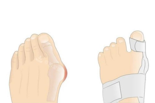 大脚骨矫正卡通图