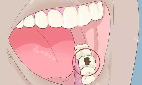 牙齿坏了