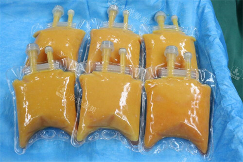 刘成胜脂肪丰胸材料展示