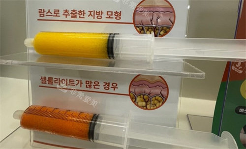 韩国365mc医院lams吸脂 韩国365mc医院lams吸脂