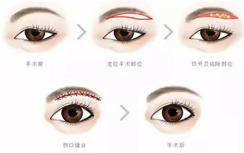 提眉手术步骤 提眉手术步骤