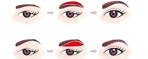 常规提眉手术步骤动画演示图 常规提眉手术步骤动画演示图