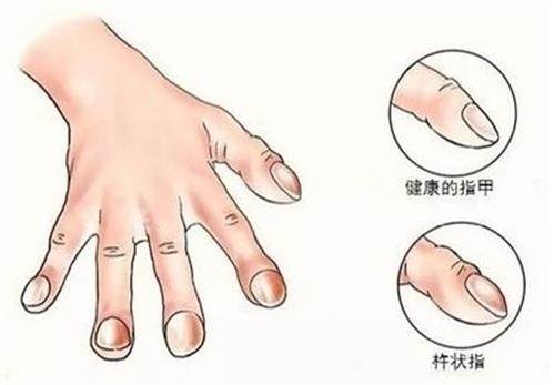 手指畸形的示意图
