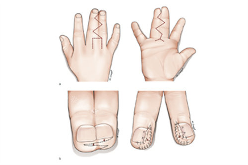 手指畸形分离术