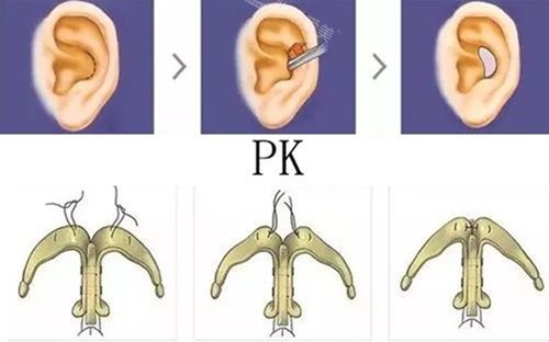 耳软骨支架隆鼻图