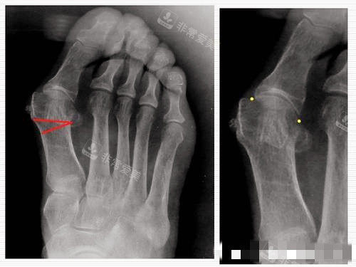 大脚骨X光片图片