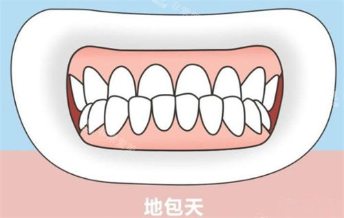 地包天卡通示意图