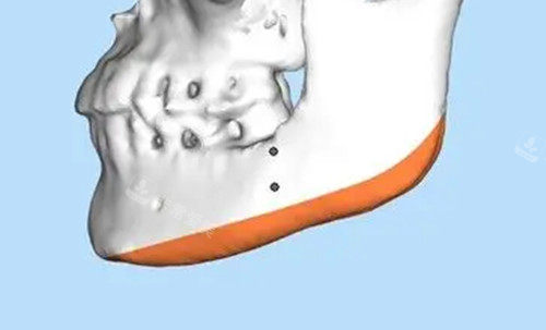 朱乐林切下颌角多少钱?价格表显示下颌角磨骨2.8万元起、长曲线截骨3万元起