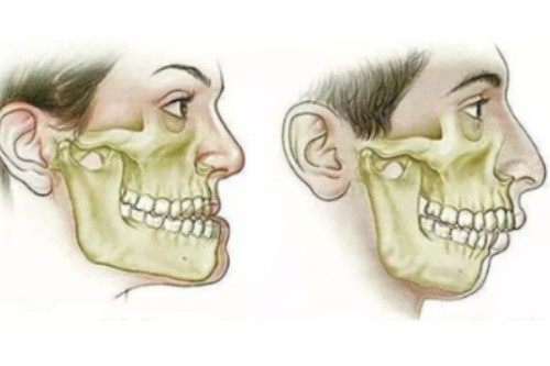 下颌角整形模型图