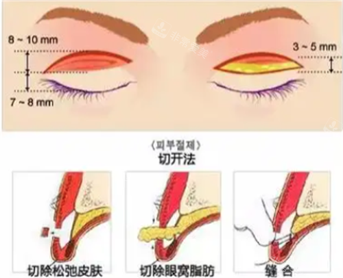 切开双眼皮手术 切开双眼皮手术