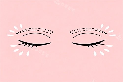 双眼皮整形卡通图 双眼皮整形卡通图